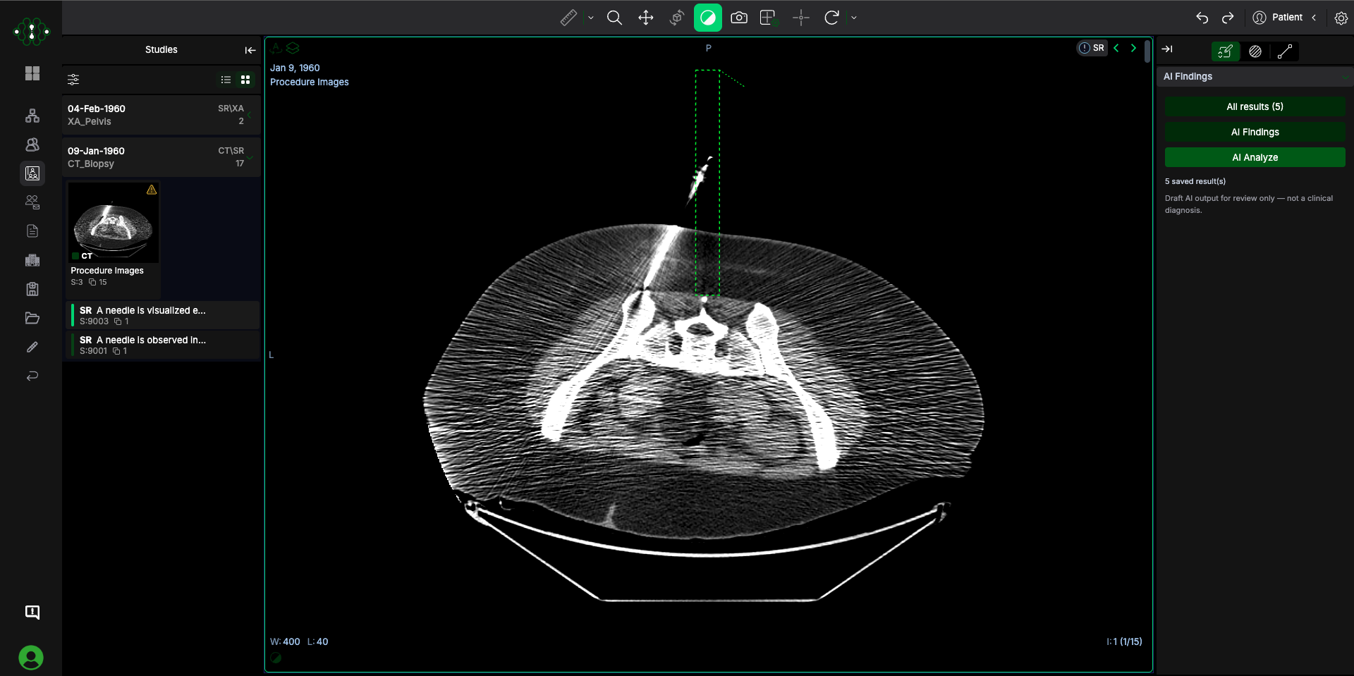 Supacognition viewer showing a CT of a percutaneous spinal procedure with the AI findings panel open