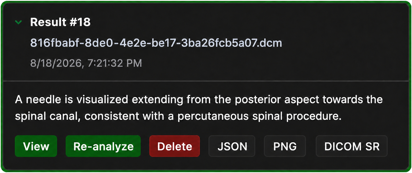 AI result: a needle is visualized extending from the posterior aspect towards the spinal canal, consistent with a percutaneous spinal procedure.