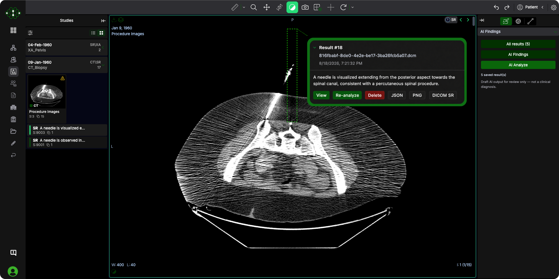 Supacognition viewer showing a CT of a percutaneous spinal procedure with the AI findings panel open